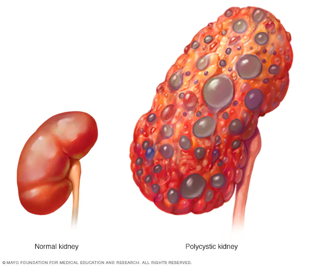 Illustration of two kidneys. The one of the left is normal and rounded. The one on the right has polycystic disease and is pocked with fluid-filled cysts and about 4 times larger than the normal kidney.